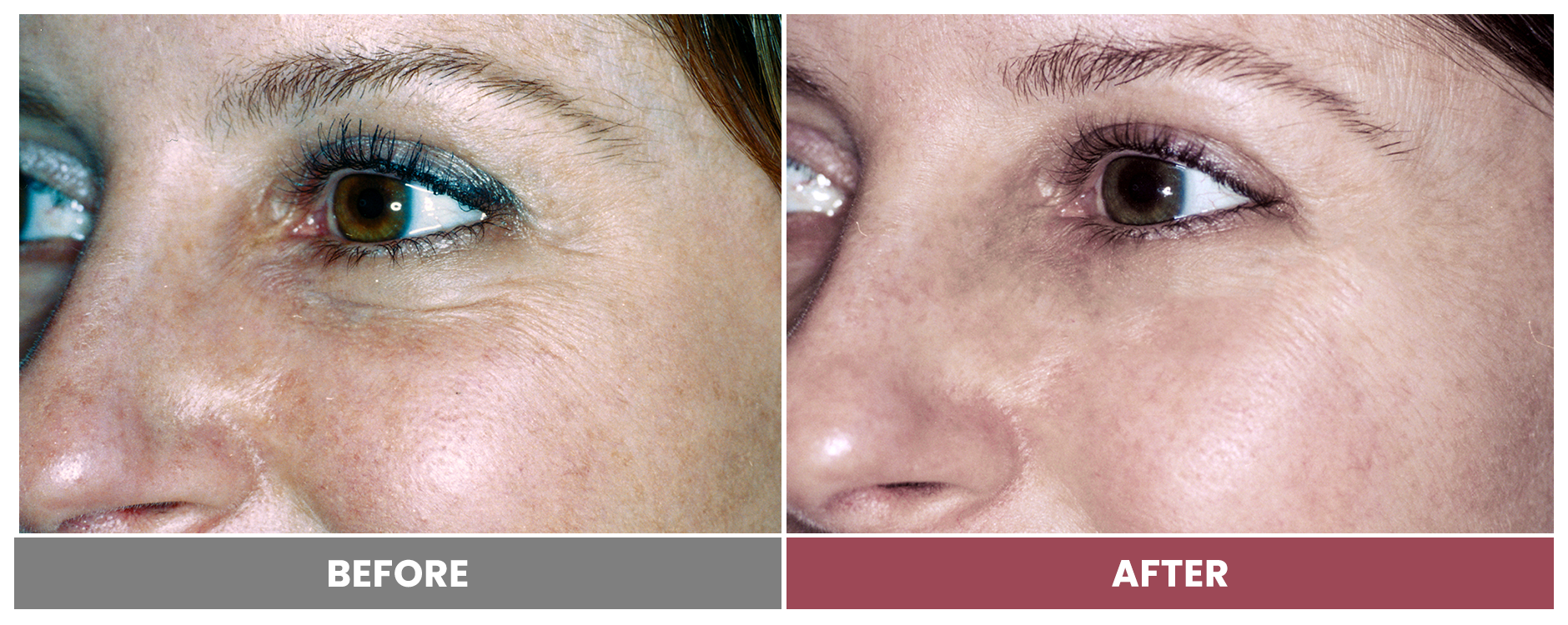 LASER SKIN RESURFACING - Case 10